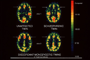 Schizophrenia 'made up of eight specific genetic disorders'