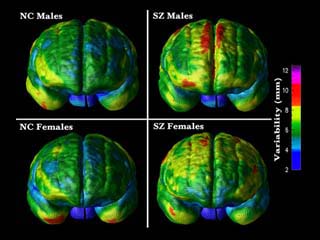 brain scan schizophrenia