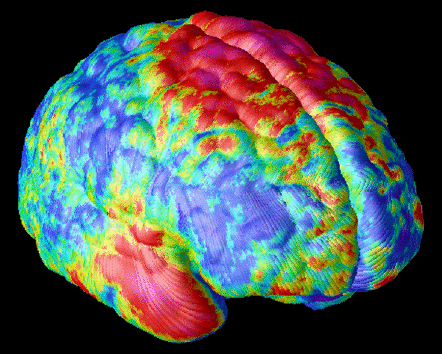 brain scan schizophrenia