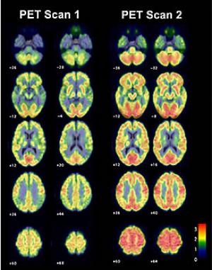 schizophrenia pet scan